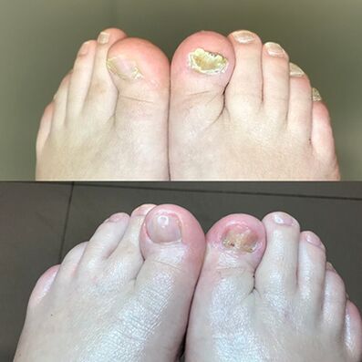 Ervaring met het gebruik van promicil crème barnabas uit Israël, foto voor en daarna