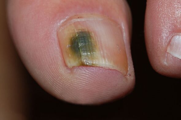 Moldy Type nagelschimmel