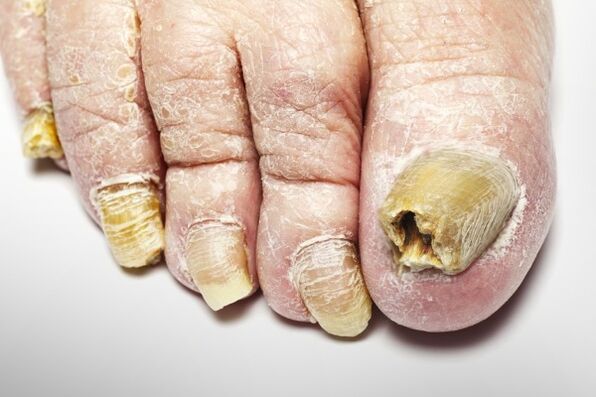 Totale versie van de nagelschimmel