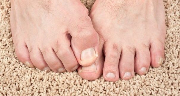 Symptomen van nagelschimmel