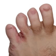 schimmel tussen de vingers