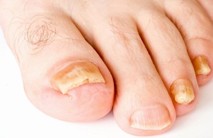 De schimmel op de duim van het been