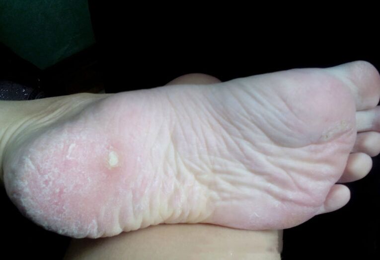 Behandeling van de schimmel met een laser