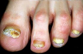 Karakterisering van de ziekte