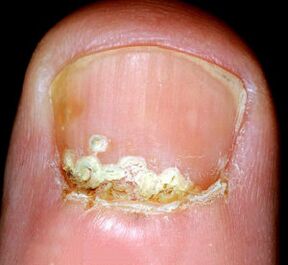 Symptomen en tekenen van de ziekte