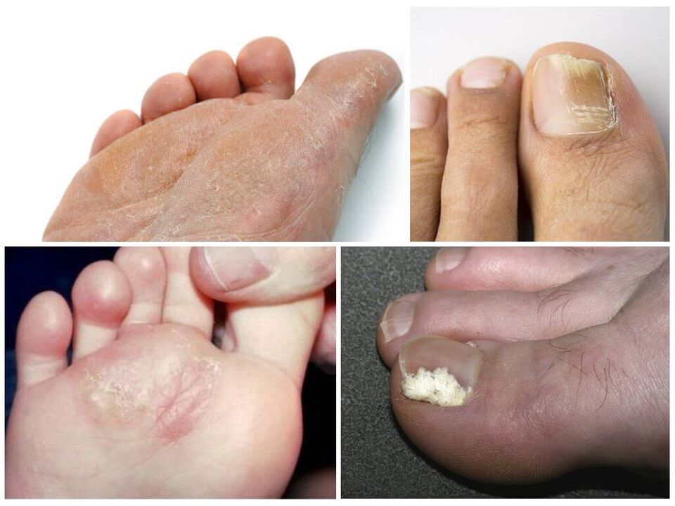 De eerste fase van voetschimmel