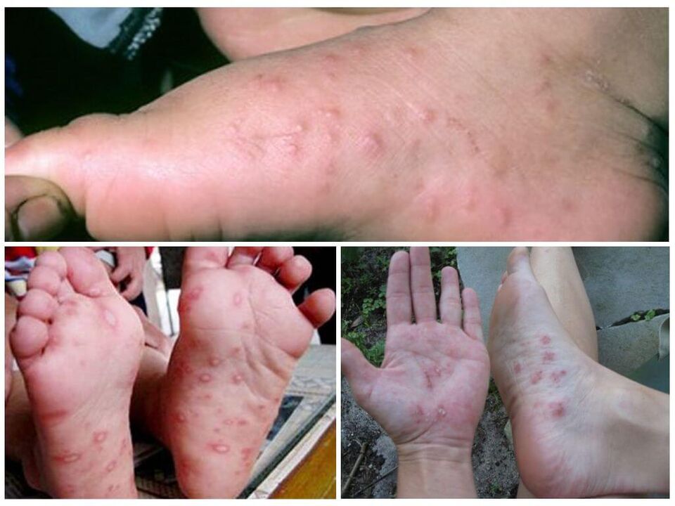 Hyperkeratotische laesies van de voeten