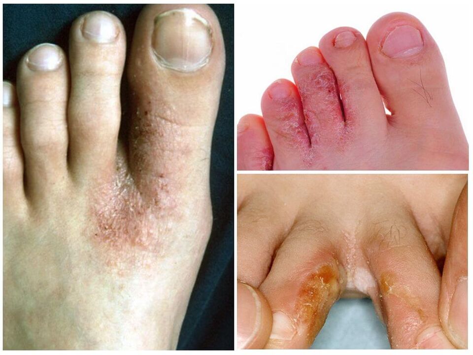 Interdigitale mycose