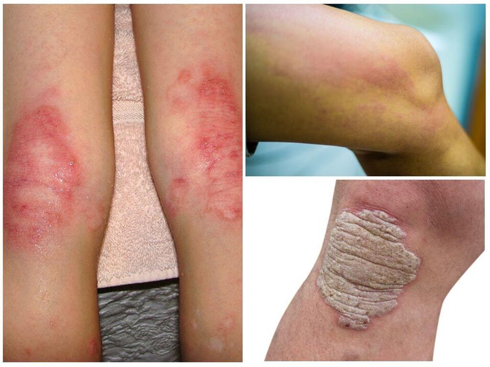 Schimmelinfecties van de knieën