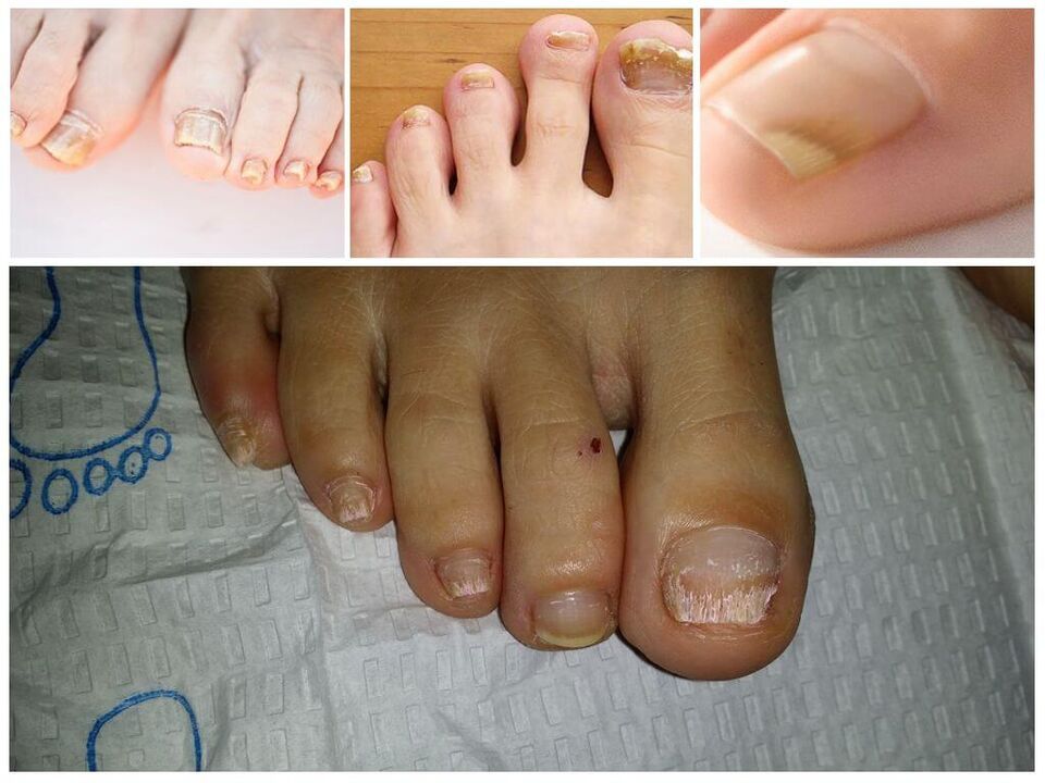 Schimmelziekten van de nagelplaten