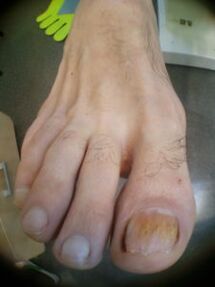 Schimmelnagel grote teen