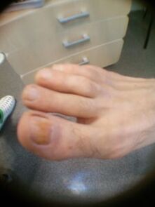 beginstadium van schimmelnagels van de grote teen