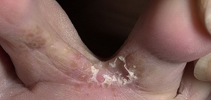 schimmel tussen de tenen