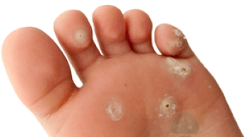 tweede fase van schimmelinfectie