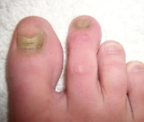 nagels die vóór de behandeling door schimmel zijn aangetast