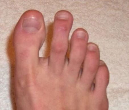 nagels na laserbehandeling voor schimmel