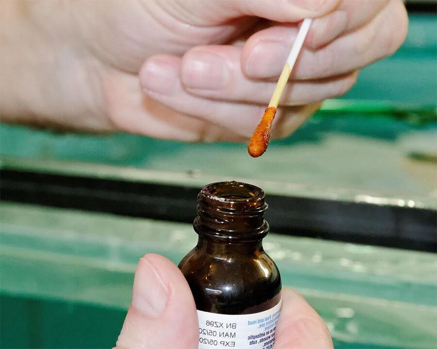Door een mengsel van jodium en stinkende gouwe-sap op de teennagels aan te brengen, wordt de schimmel verwijderd