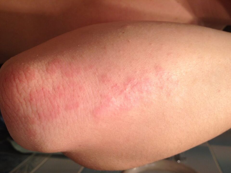 Een allergische reactie in de vorm van uitslag op de huid van de elleboog na het aanbrengen van een druppel stinkende gouwe-sap